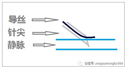 中心静脉穿刺 三思而后行